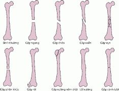 Figure: Các loại đường gãy phổ biến - Cẩm nang MSD - Phiên bản dành cho  chuyên gia