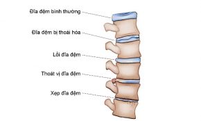 Thoái hóa cột sống: triệu chứng, biến chứng, nguyên nhân và cách điều trị